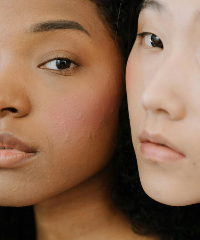 Why Inflammation Is Giving You Adult Acne And What To Do About It, According To Skincare Experts